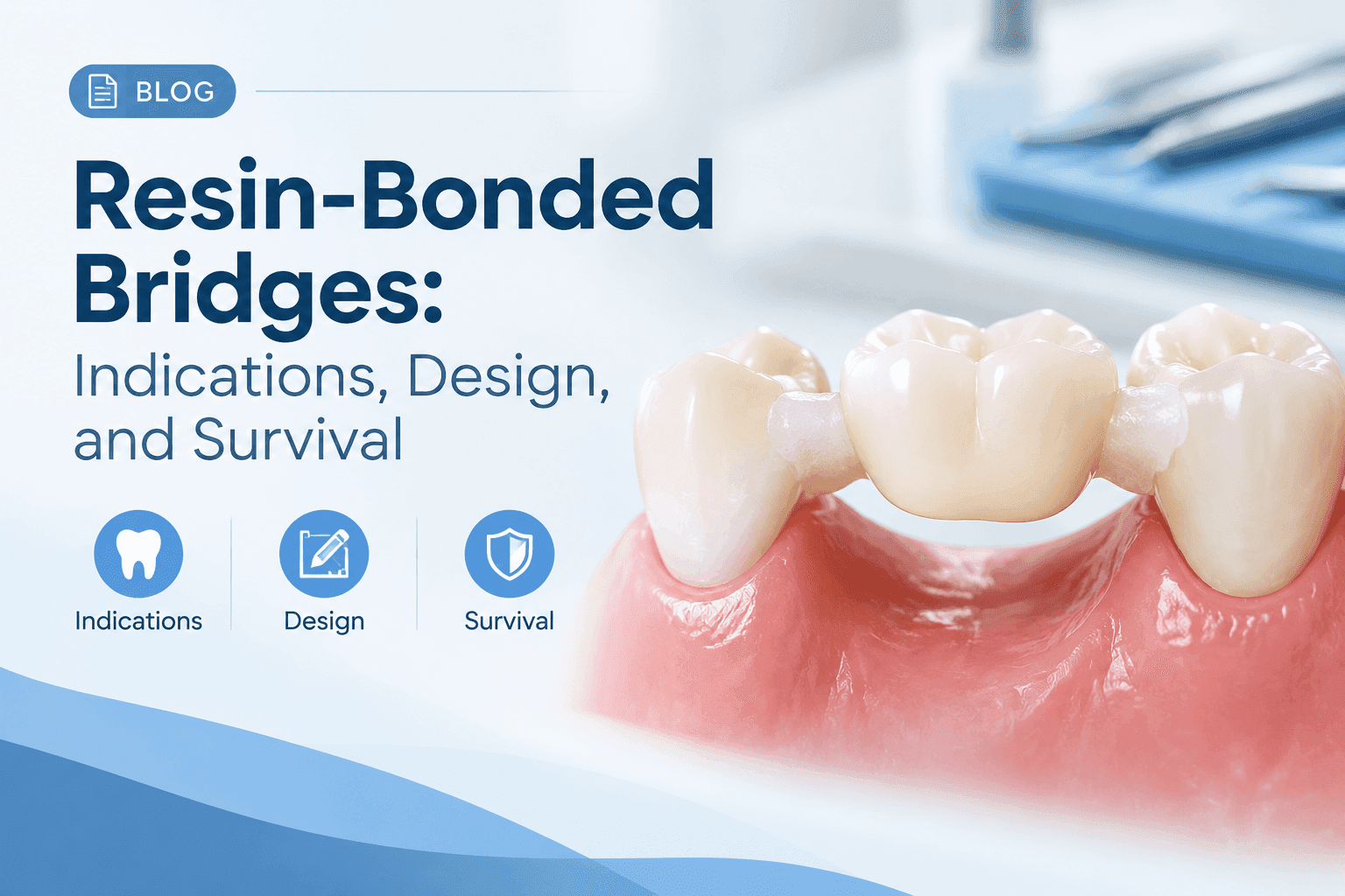 Resin-Bonded Bridges: Indications, Design, and Survival